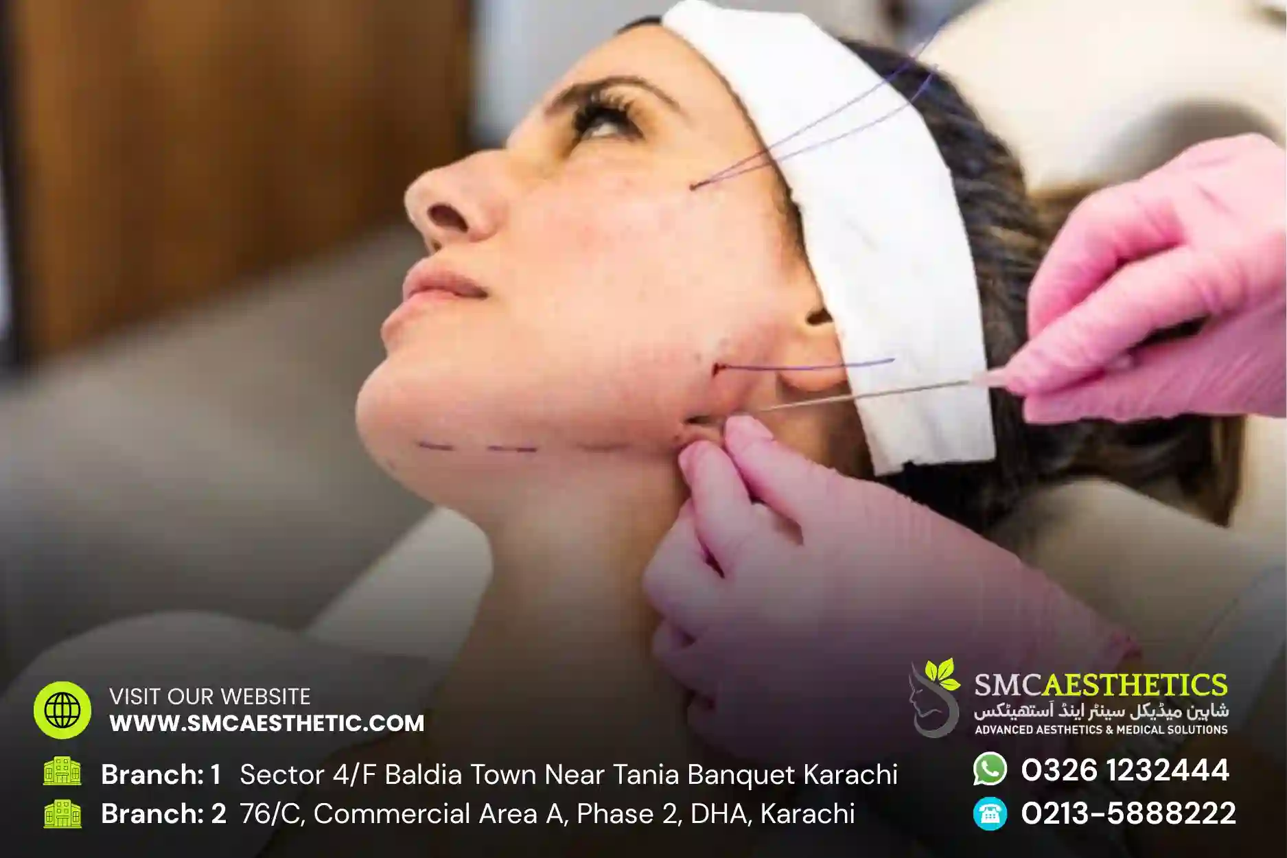 Thread Lift Treatment in Karachi - PDO Thread Face Lift at SMC Aesthetics